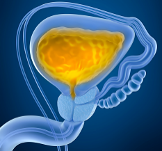 bacterial prostatitis with inflamed prostate and infected bladder